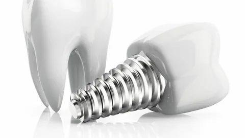 dental implants Leichhardt